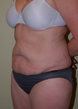Before Image: Tummy Tuck with Liposuction - left-front-oblique