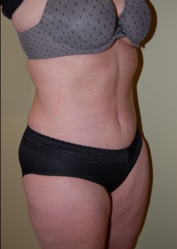 After Image: Tummy Tuck with Liposuction - right-front-oblique