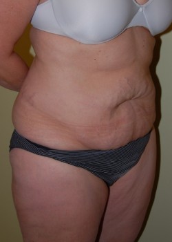 Before Image: Tummy Tuck with Liposuction - right-front-oblique