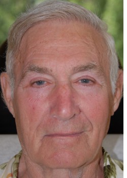 After Image: Upper and Lower Eyelid Surgery - front