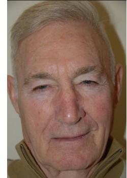 Before Image: Upper and Lower Eyelid Surgery - front