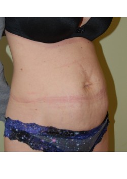 Before Image: Tummy Tuck - right-front-oblique