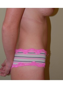 After Image: Tummy Tuck - other