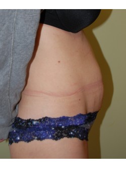 Before Image: Tummy Tuck - other