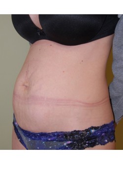 Before Image: Tummy Tuck - left-front-oblique