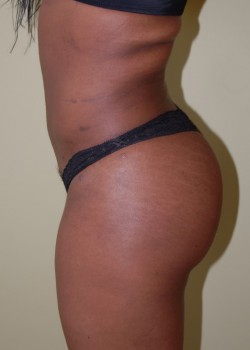 After Image: Brazilian Butt Lift - other