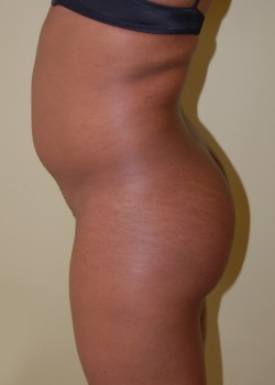 Before Image: Brazilian Butt Lift - other