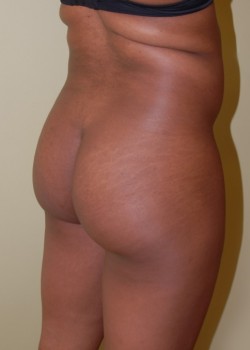 Before Image: Brazilian Butt Lift - right-front-oblique