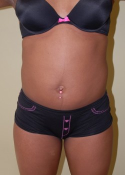 Before Image: Liposuction - front