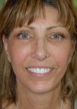 After Image: Face Lift, Lower Eyelid Surgery - front