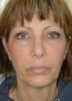 Before Image: Face Lift, Lower Eyelid Surgery - front