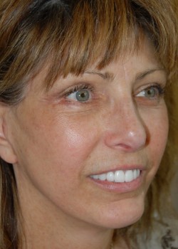 After Image: Face Lift, Lower Eyelid Surgery - right-front-oblique