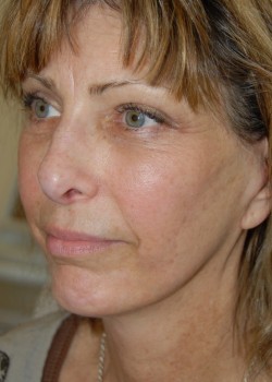 After Image: Face Lift, Lower Eyelid Surgery - left-front-oblique