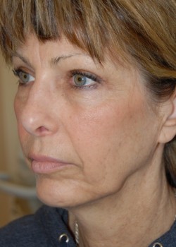 Before Image: Face Lift, Lower Eyelid Surgery - left-front-oblique