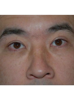 After Image: Asian Double Eyelid - front