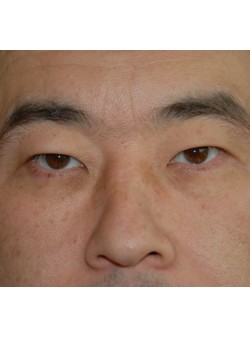 Before Image: Asian Double Eyelid - front