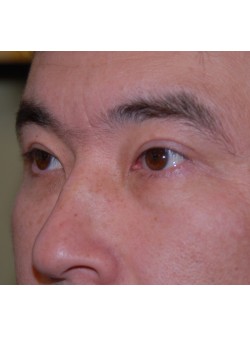 After Image: Asian Double Eyelid - left-front-oblique