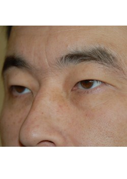 Before Image: Asian Double Eyelid - left-front-oblique