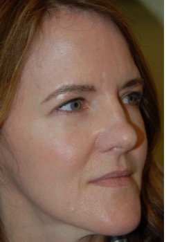 After Image: Upper and Lower Eyelid Surgery - right-front-oblique