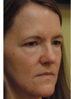 Before Image: Upper and Lower Eyelid Surgery - right-front-oblique