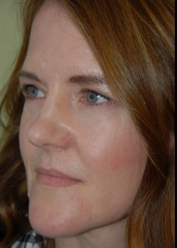 After Image: Upper and Lower Eyelid Surgery - left-front-oblique