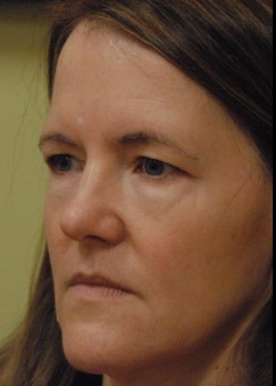 Before Image: Upper and Lower Eyelid Surgery - left-front-oblique