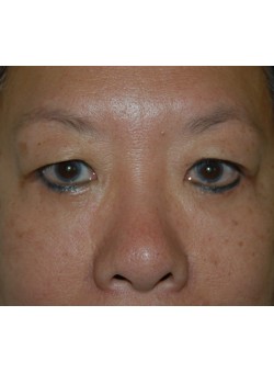 After Image: Lower Eyelid Surgery - front