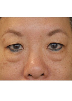 Before Image: Lower Eyelid Surgery - front