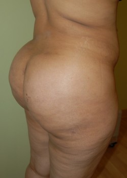 After Image: Brazilian Butt Lift - right-front-oblique