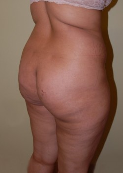 Before Image: Brazilian Butt Lift - right-front-oblique