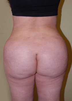 After Image: Brazilian Butt Lift - front