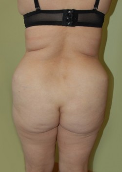Before Image: Brazilian Butt Lift - front