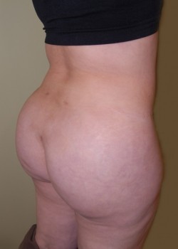 After Image: Brazilian Butt Lift - right-front-oblique