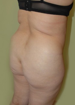 Before Image: Brazilian Butt Lift - right-front-oblique