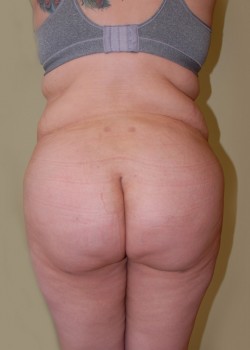 After Image: Brazilian Butt Lift - front