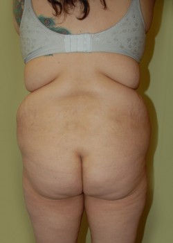 Before Image: Brazilian Butt Lift - front