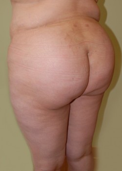 After Image: Brazilian Butt Lift - left-front-oblique