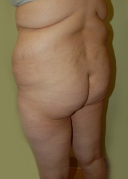 Before Image: Brazilian Butt Lift - left-front-oblique