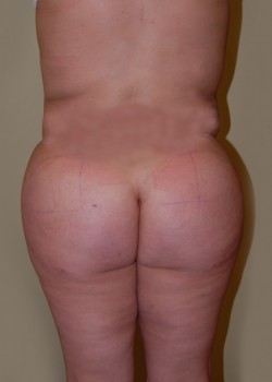 After Image: Brazilian Butt Lift - front