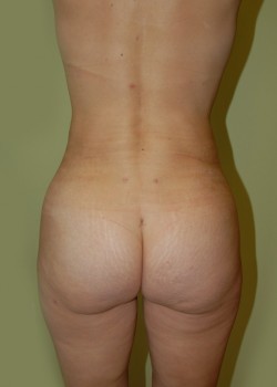After Image: Brazilian Butt Lift - front