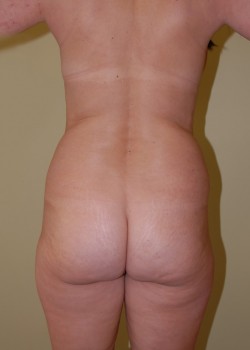 Before Image: Brazilian Butt Lift - front