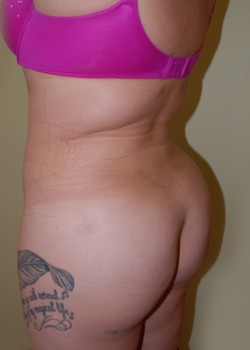 After Image: Brazilian Butt Lift - left-front-oblique