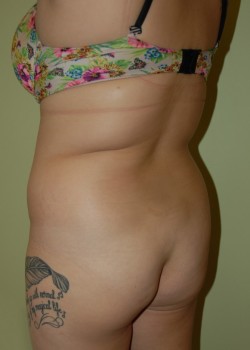 Before Image: Brazilian Butt Lift - left-front-oblique