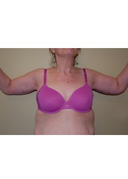 After Image: Arm Lift - front