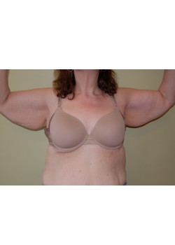 Before Image: Arm Lift - front