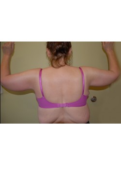 After Image: Arm Lift - back