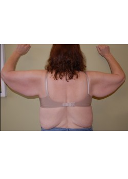 Before Image: Arm Lift - back