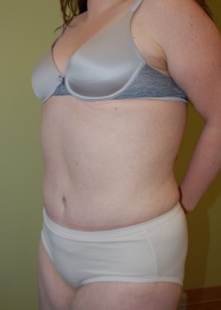 After Image: Tummy Tuck with Liposuction - left-front-oblique
