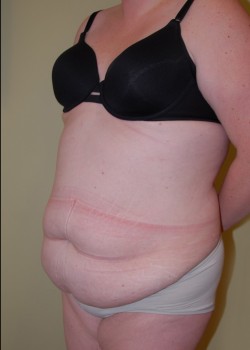 Before Image: Tummy Tuck with Liposuction - left-front-oblique