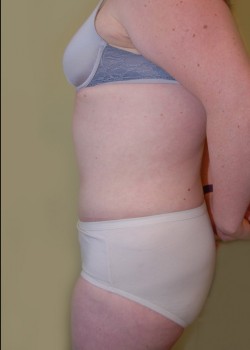 After Image: Tummy Tuck with Liposuction - other